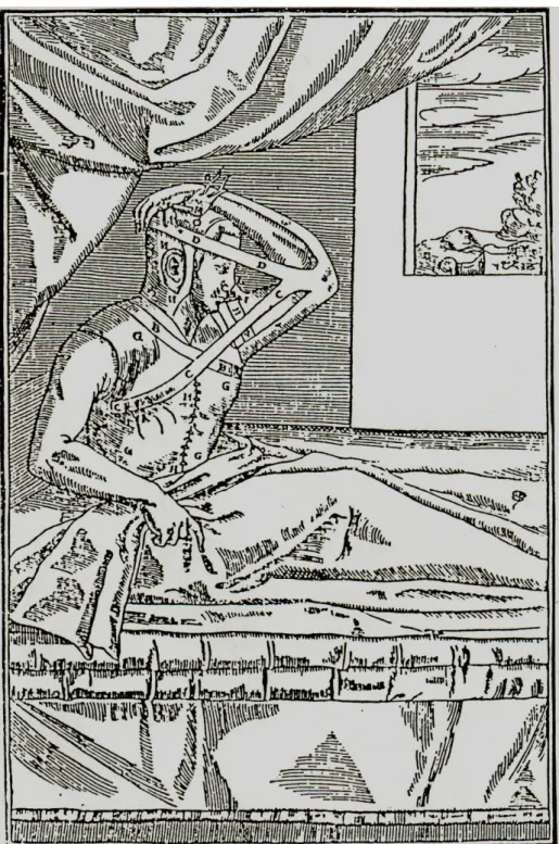 Figure 1 : Reconstruction nasale par un lambeau tubulé brachial reporté par Tagliacozzi au XVI ème siècle 