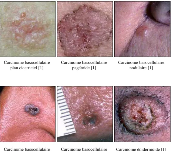 Figure 5 : Les carcinomes cutanés. 