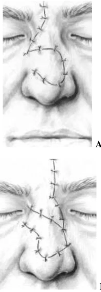 Figure 13 [126] : Cascade flap d’Emmet. 