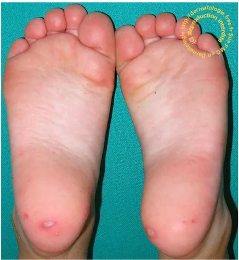 Figure 11 : Syndrome mains-pieds-bouche (3) 