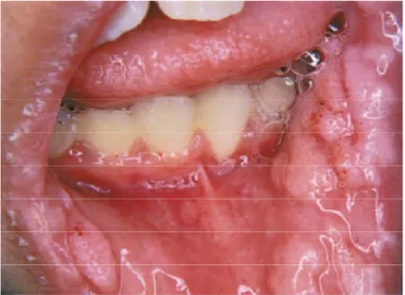 Figure 12 : Hyperplasie épithéliale focale   (infection par Human papillomavirus[HPV])