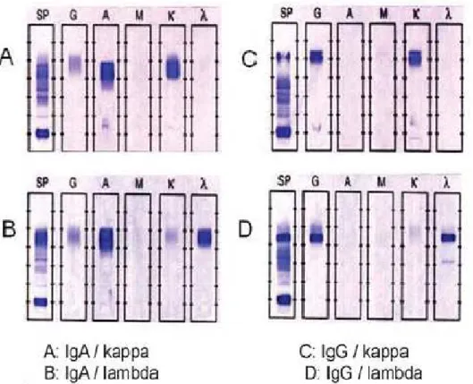 Figure 4 : L'immunofixation sérique sur gel d’agarose des patients atteints  de myélome multiple(41) 