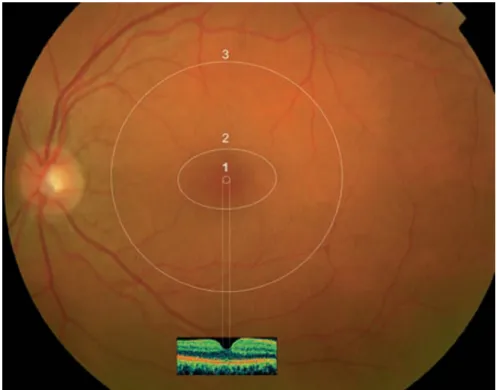 Figure n° 1 : Image du fond d’oeil et aspect en tomographie en cohérence   optique (OCT) en analyse temporelle (time domain)