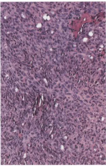 Figure 4 : Tumeur mixte bénigne avec prédominance de la composante  épithéliale. 