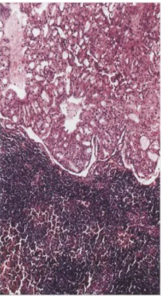 Figure 5 : Oncocytome de la glande lacrymale. 