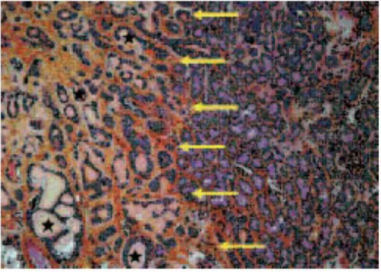 Figure 6 : Microscopie, à droite, aspect histologique normal de la glande lacrymale, à gauche  (zone délimitée par des flèches), lésion tumorale correspondant à un Cylindrome ou 