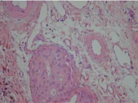 Figure 8 : Examen au grossissement X 40, après coloration à l’HES. Présence de tubes isolés  au sein d’un stroma myxoïde (tumeur mixte maligne)