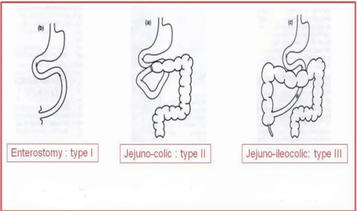 Figure 3 : Formes anatomiques du syndrome du grêle court 