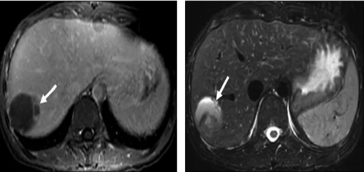 Fig 24 : métastase hépatique unique au niveau du foie, d’une tumeur pseudopapillaire et  solide du pancréas, sur une IRM