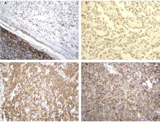 Fig 31 : Aspect immunohistochimique de différente tumeurs pancréatiques, après un  marquage à l’AC anti-CD99 par (A et B : tumeur pseudopapillair et solide du pancréas ;C : 