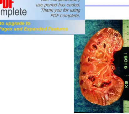 Fig. L 7 : Maladie de Kaposi du rein, macroscopie (Collection A.Viellefond). 