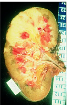 Fig.  L 10 : Métastase, macroscopie (collection A.Viellefond). 