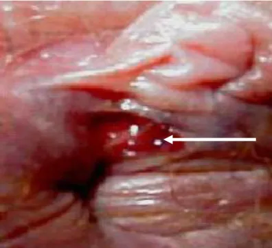 Fig. 9 : Fissure anale postérieure jeune : Forme hyperalgique [46]. 