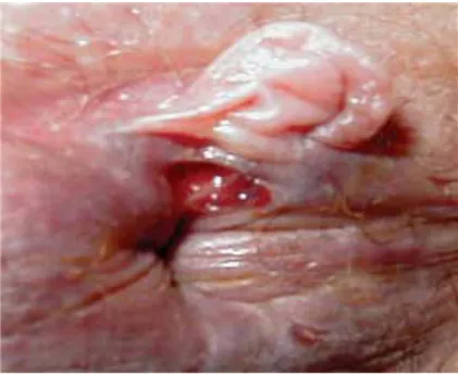 Fig. 14 : Fissure anale chronique [14]. 