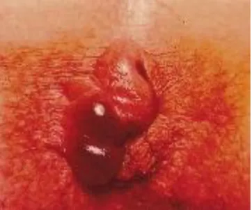 Fig. 26: Thromboses hémorroïdaires externes multiples [7]. 