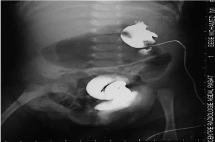 Figure 18 : L’opacification à travers le catheter de néphrostomie montre un uretère  gauche tortueux  dilaté, communicant avec une vessie fermée gauche 