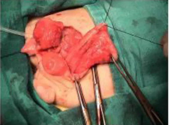 Figure 29 : vue opératoire montrant (1) la vessie dupliquée couverte ; (2) le colon  dupliqué sans communication avec l’intestin normal