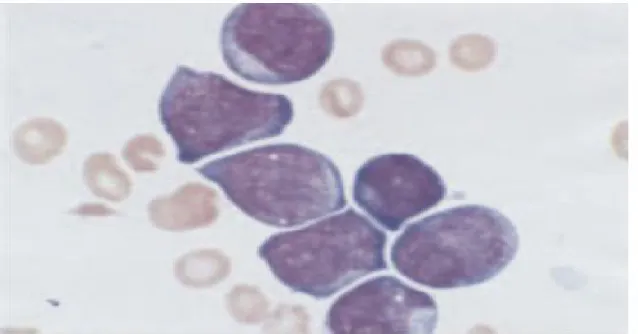 Figure  1 :  Microphotographie  d'un  frottis  sanguin,  d'un  patient trisomique  21,  présentant  une  leucémie  transitoire