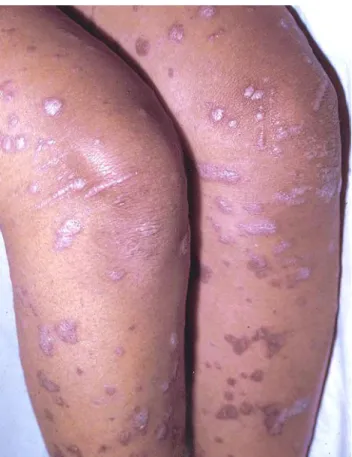Figure 5 : Lichen plan (plaques et papules violacées   surmontées de squames) [10] 