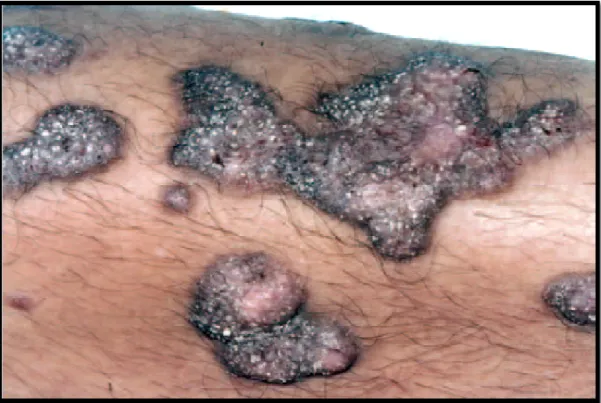 Figure 6 : lichen plan hypertrophique [1] 