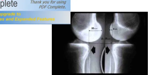 Figure N°12 : Importante rupture du LCA avec tiroir de 30mm, à  comparer au tiroir normal (5mm) du genou opposé 