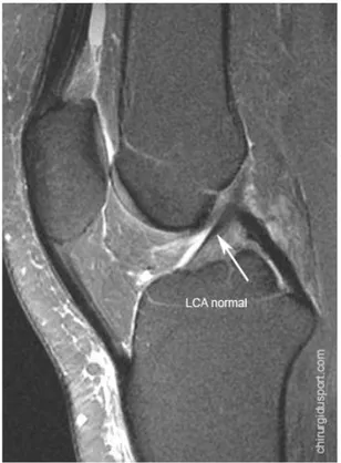 Figure N°13 : Aspect normal du LCA en IRM apparaît comme une bande  de signal hypo-intense 