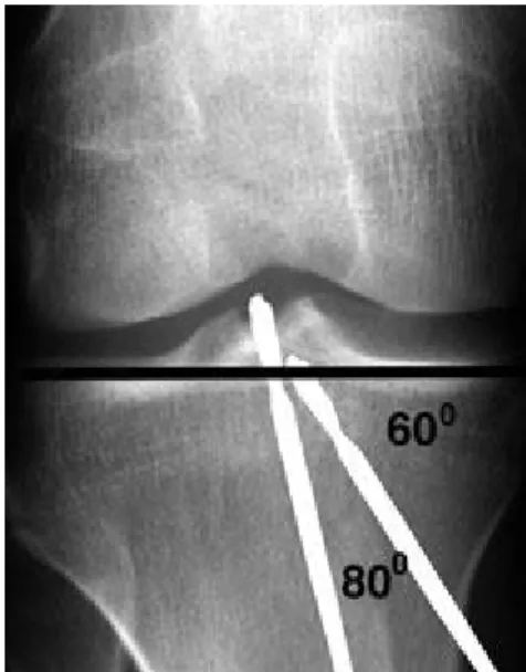 Figure N°22 : L’angle que la broche tibiale forme avec l’interligne  articulaire interne 