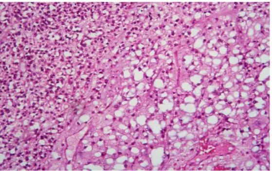 Figure 10 : Prolifération tumorale à cellules rondes au sein d’un stroma myxoïde 
