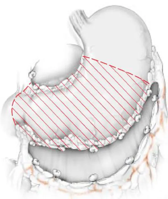 Figure 12 : Gastrectomie des deux tiers [58] 