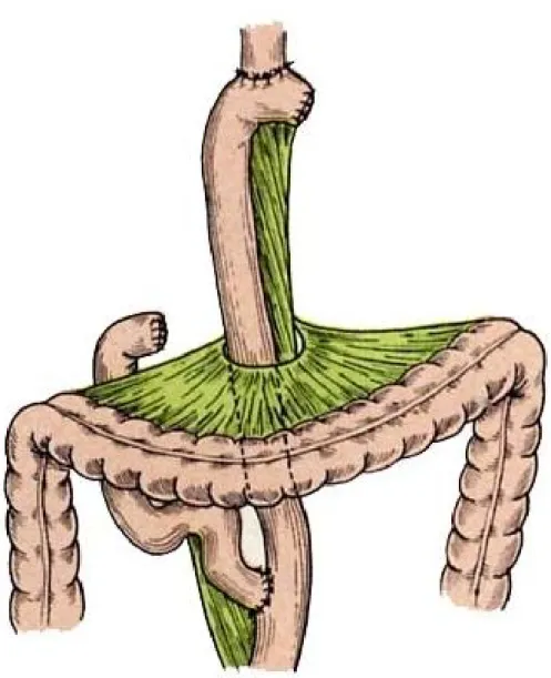Figure 16 :  Gastrectomie totale avec anastomose oeso-jéjunale sur anse en Y [60] 