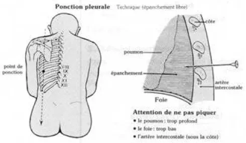 Figure 4: TECHNIQUE DE PONCTION PLEURALE [21]