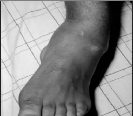 Fig. 14 :Déformation du pied avec saillie de l’astragale en externe 