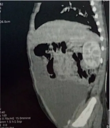 Figure 16: TDM abdominale coupe sagittale. 
