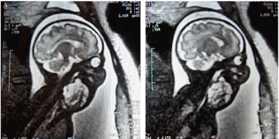 Figure  4  A.  Coupe  sagittale  en  IRM  :  masse  cervicale  en  hypersignal  T2  hétérogène,  cloisonnée  s’étendant  en  haut  à  l’angle  mandibulaire,  en  bas  à  la  région thoracique postérieure