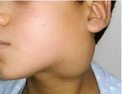 Figure 9 :  Masse cervico-parotidienne gauche