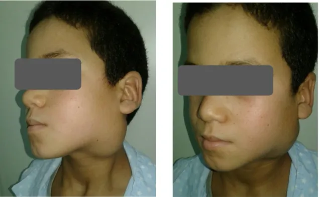 Figure 15 : Patient 1 Avant chirurgie 