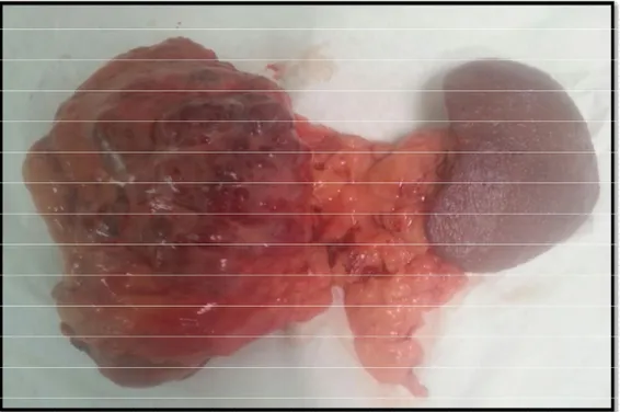 FIGURE 7 : image de la pièce de splénopancréatectomie caudale emportant la masse  kystique et corps du pancréas (service de chirurgie viscérale I, HMIMV)