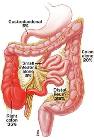 Figure 3: Localisation des lésions dans la maladie de Crohn 