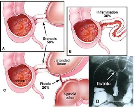 Figure 5: Représentation des fistules et des sténoses dans la maladie de Crohn 