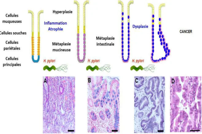 Figure 13: Schéma représentant l’évolution du processus métaplasique induit par l’infection à  H.pylori vers l’adénocarcinome gastrique [135]