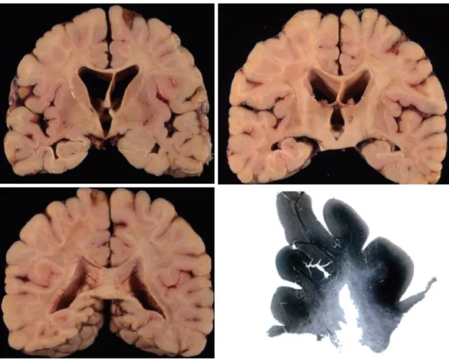 Figure 7 :  Examen neuropathologique des hémisphères cérébraux chez un adulte avec une pure  forme cérébrale de l’X-ALD
