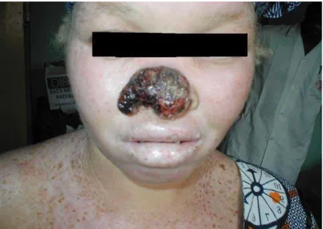Fig 5 : Carcinome baso cellulaire du nez 