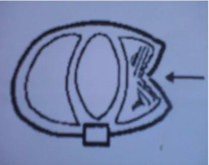 Figure 1 : Schéma d’une contusion pulmonaire   post-traumatique (3) 