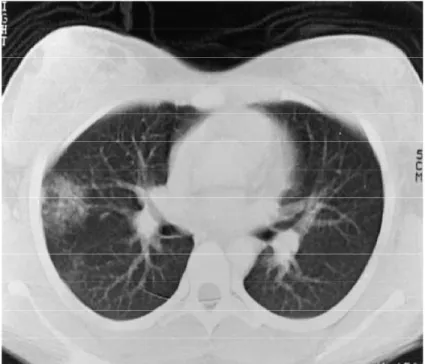 Figure 8 : Image scanographique d’une contusion pulmonaire gauche 