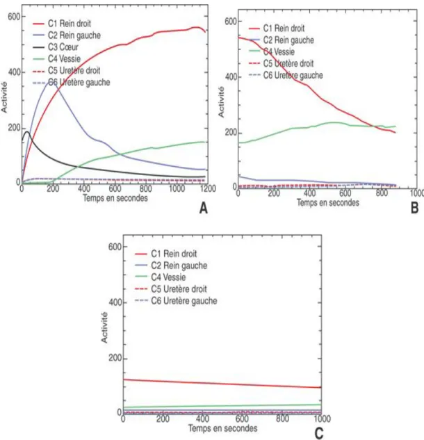 Figure .1 : Suivi d'une hydronéphrose droite de découverte périnatale, opérée. Scintigraphie rénale après   administration de 30 MBq de  99m Tc-MAG 3 [41]