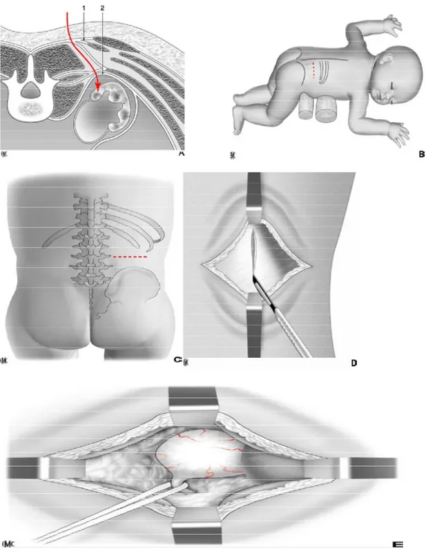 Figure  .1 :  Voie  lombaire  postérieure  (côté  droit)  [26].A.  Coupe  transversale  du  tronc  au  niveau  de  L2,  de  type  «  scanner  »