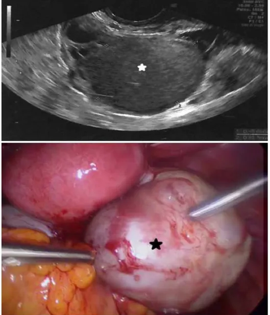 Fig. 3 : Aspect coelioscopique (étoile noire) et échographique (étoile blanche)   de l’endométriome de la patiente n°4 : endométriome de 6 cm de l’ovaire droit, 