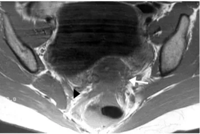 Fig. 6 : Imagerie par résonance magnétique, séquence pondérée en T1 : nodule de la cloison  recto-vaginale avec extension aux ligaments utéro-sacrés et adhérences