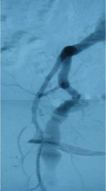 Figure 5: Artériographie du membre inférieur droit montrant un anévrisme de L’ASP droite  continuant une artère iliaque interne qui n’a pas été initialement reconnue