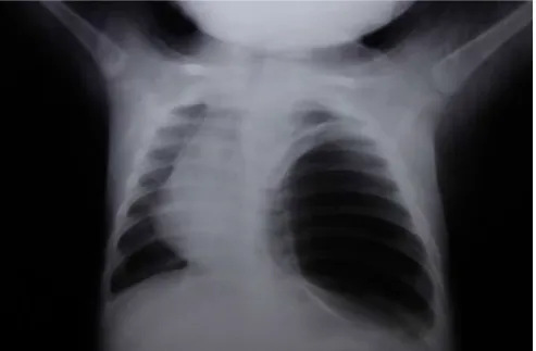 Figure 18: radiographie thoracique de face montrant une hyperclarté   à gauche et refoulement médiastinal vers la droite
